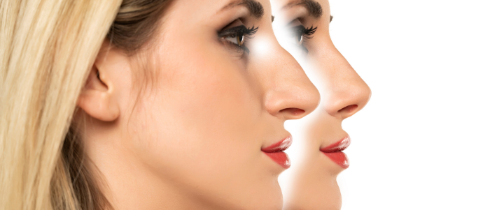 Choosing the Right Path: An In-Depth Look at Different Rhinoplasty Procedures