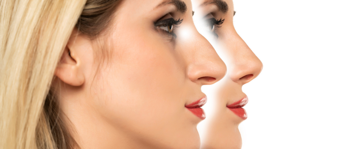 rhinoplasty