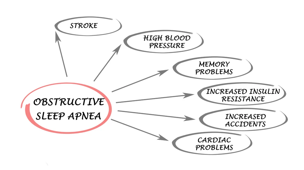 Obstructive sleep apnea health concerns