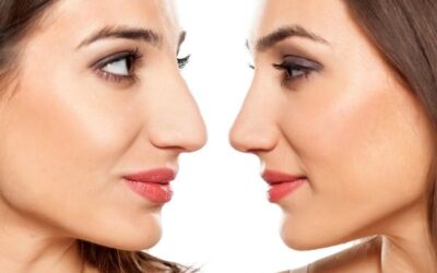 The Price Of An Effective Rhinoplasty In Los Angeles, California.