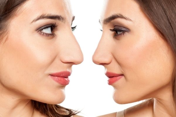 The Price Of An Effective Rhinoplasty In Los Angeles, California.