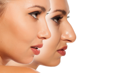 From Aesthetics to Functionality: Your Guide to Rhinoplasty’s Common Questions and Insights