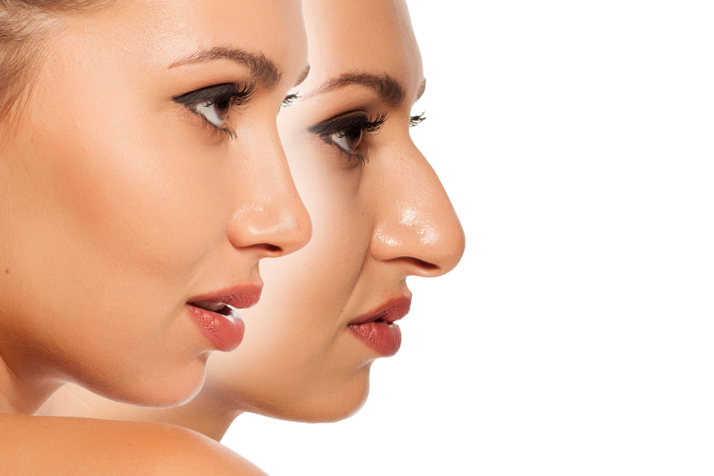 From Aesthetics to Functionality: Your Guide to Rhinoplasty’s Common Questions and Insights