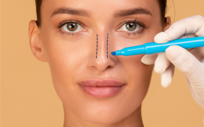 From Consultation to Recovery: 20 Rhinoplasty Questions to Keep in Mind