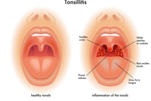 Tonsillitis